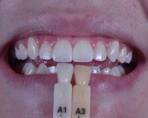 Imagem comparando antes e depois do clareamento dental