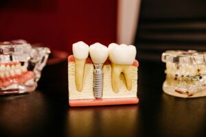 Imagem que ilustra o que é um implante dentário