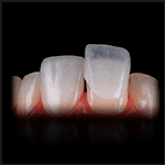 Lentes de contato dentais - Rideto Odontologia e estética