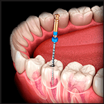 Tratamento de canal - Rideto Odontologia e estética