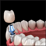 Implantes dentários - Rideto Odontologia e estética