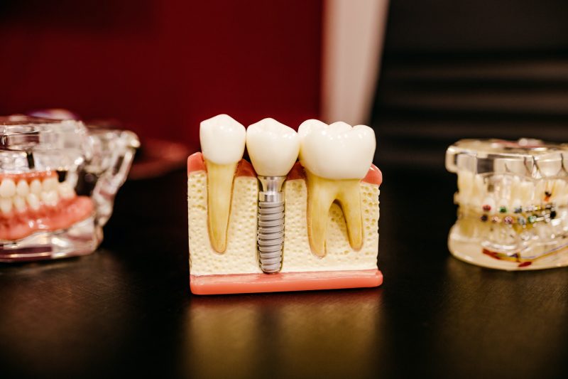 Implantes dentários - Rideto Odontologia e Estética